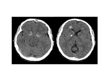 : Brain_computer_tomography_cuts_of_the_patient_with_22q11